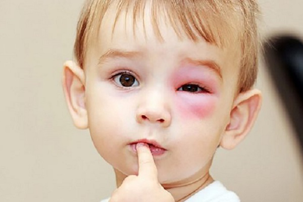 Số trẻ em bị đau mắt đỏ đang tăng cao