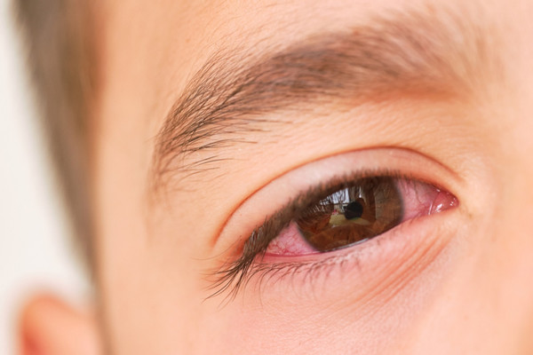 Bệnh đau mắt đỏ lây lan qua nước uống là thông tin thiếu khoa học