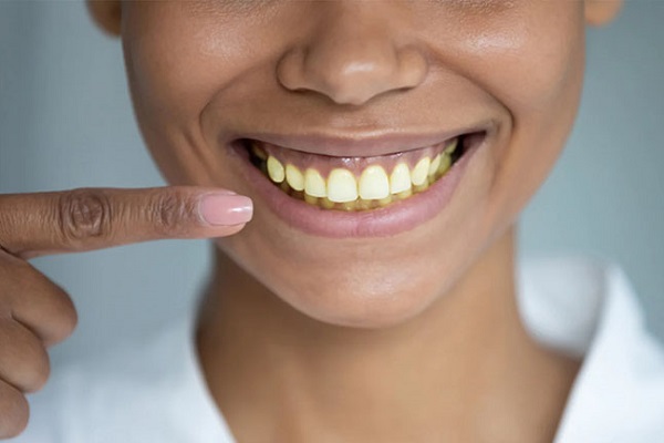 Lưu ý về cách tẩy trắng răng để tránh tiền mất tật mang