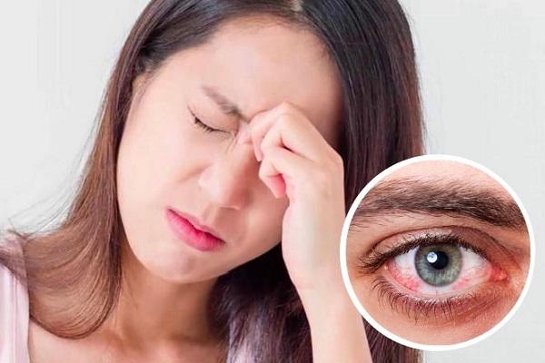 Làm gì để giảm các triệu chứng đau mắt đỏ tại nhà?