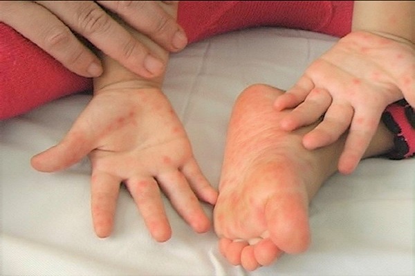 Cẩm nang chăm sóc trẻ mắc bệnh tay chân miệng tại nhà