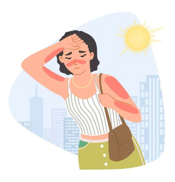 5 thực phẩm 'cứu nguy' cho da cháy nắng