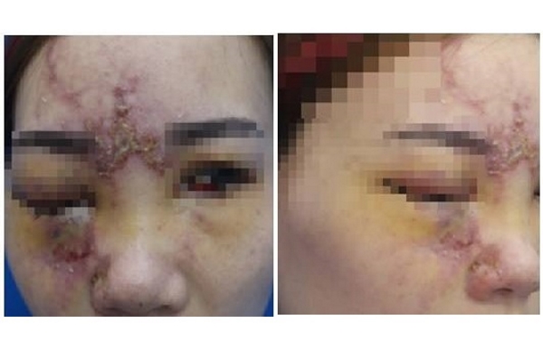 Qua Đài Loan nâng mũi, một phụ nữ có nguy cơ mù mắt