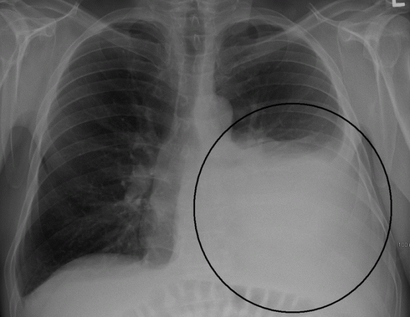 Lời cảnh báo về căn bệnh tràn dịch màn phổi từ sự ra đi đột ngột của chàng Stylist
