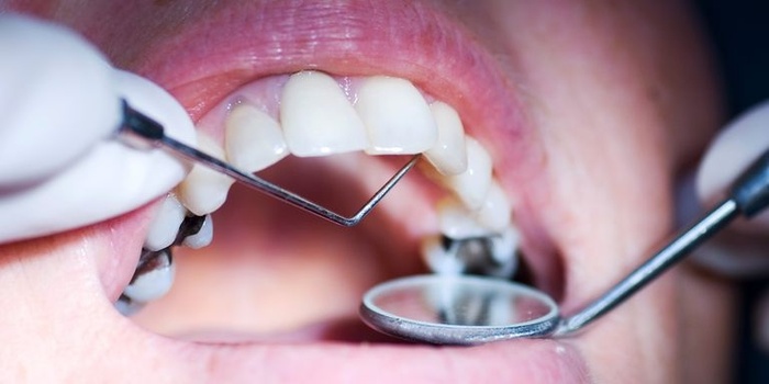 Bí quyết cho hàm răng chắc khỏe
