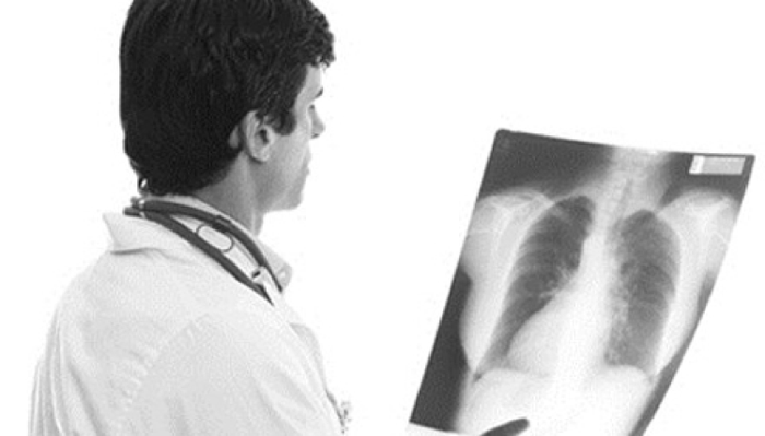 Bệnh ung thư phổi và điều nên biết để phòng