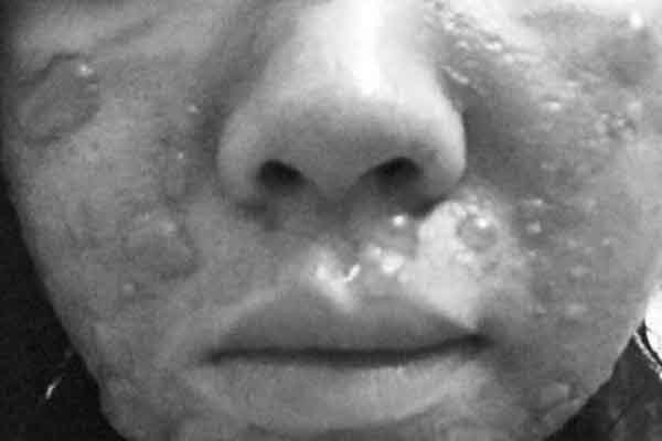 Mặt bị phù nề, biến dạng dùng mỹ phẩm lột da tại nhà