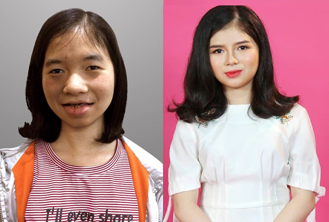 Cô gái ‘ma cà rồng’ lột xác thành hotgirl sau 5 lần phẫu thuật thẩm mỹ