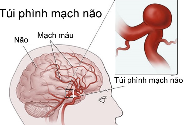 Triệu chứng của phình động mạch não, cần biết để đề phòng