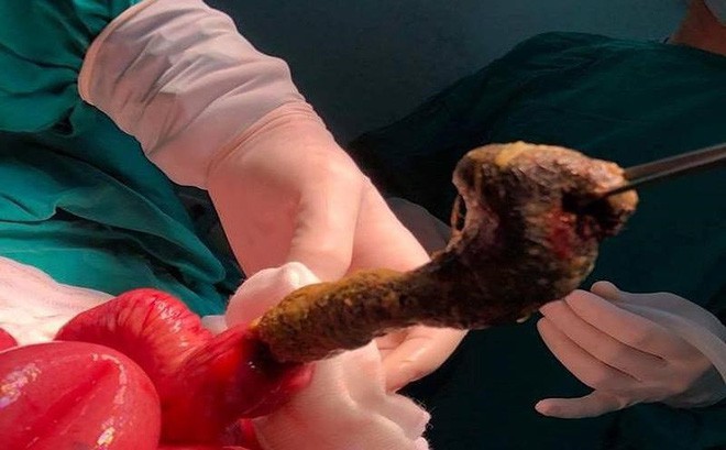 Bé gái 6 tuổi ăn tóc của mình do mắc hội chứng “công chúa tóc mây”