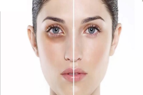 Bật mí cách che quầng thâm và bọng mắt nhanh