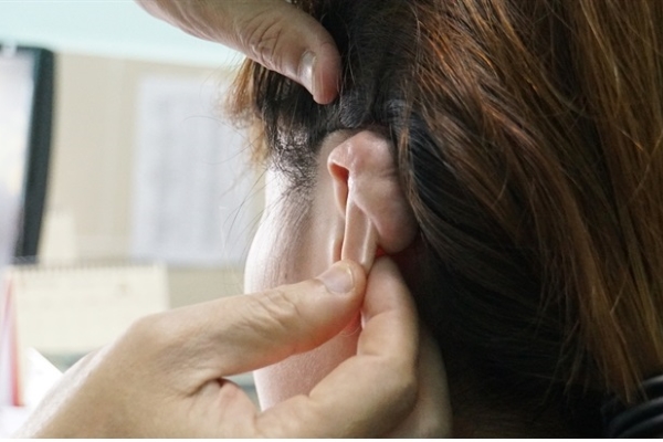 Cô gái bị sẹo “khổng lồ” vì bấm lỗ vành tai theo mốt