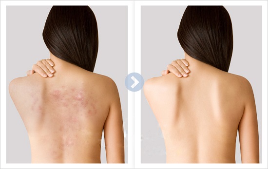 Đánh bay mụn lưng với những nguyên liệu đơn giản