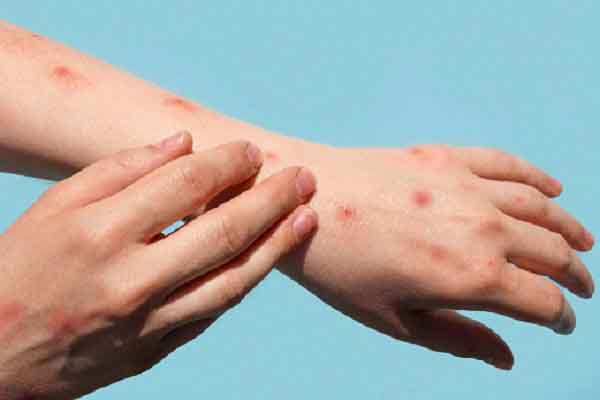 Bệnh đậu mùa khỉ có thể lây lan trước khi các triệu chứng xuất hiện