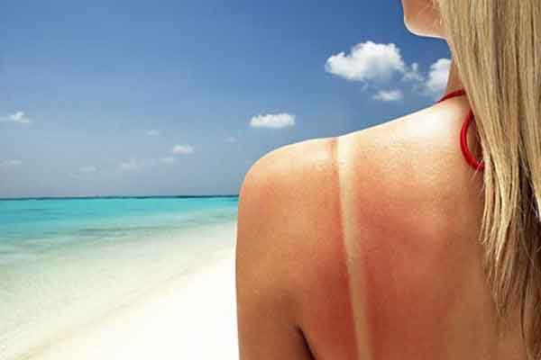 Phải làm gì khi da bị bỏng nắng?