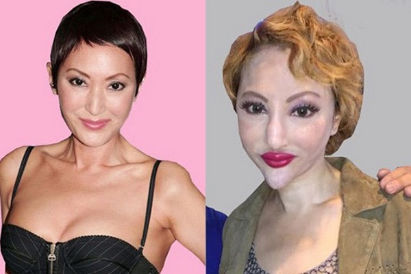 Sao và biến chứng do phẫu thuật thẩm mỹ