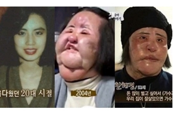 Han Mi Ok – thảm họa dao kéo xứ Hàn đã qua đời