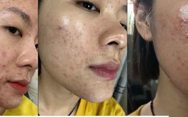 Kinh nghiệm “tiêu diệt” sạch mụn chỉ sau 5 tháng