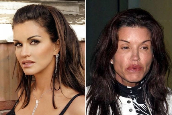 Sao thế giới mặt biến dạng vì phẫu thuật thẩm mỹ