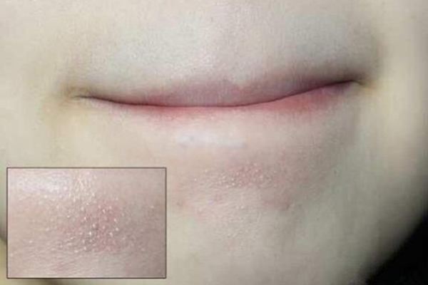 Mách bạn những cách “tiêu diệt” mụn cám ở cằm