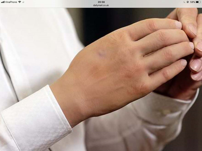 Phát minh mới: cánh tay robot nhẹ, rẻ và hoàn hảo nhất cho người khuyết chi