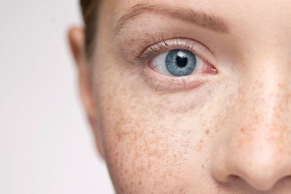 Tại sao tàn nhang lại đậm màu hơn vào mùa hè?