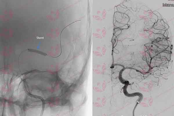 Bệnh viện đầu tiên ứng dụng trí tuệ nhân tạo để điều trị bệnh đột quỵ