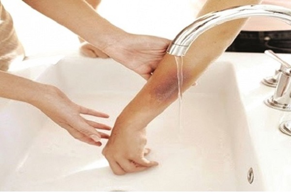 Bỏng bô xe máy – chữa cách nào nhanh lành?