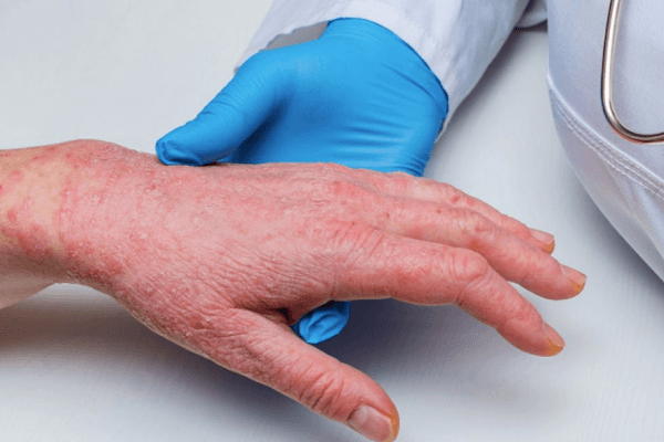 Ghi nhận ca tử vong đầu tiên do đậu mùa khỉ tại châu Âu