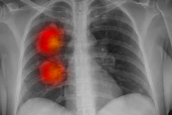 Công cụ trí tuệ nhân tạo có thể xác định chính xác bệnh ung thư