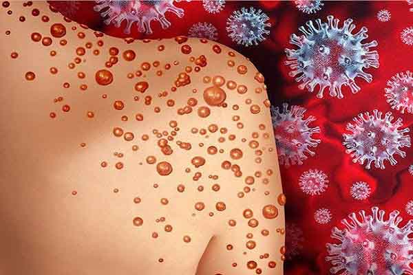 Để ngăn chặn bệnh đậu mùa khỉ cần có sự phối hợp toàn cầu