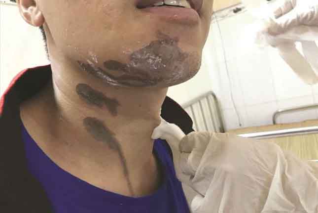 Một người đàn ông bị bỏng nặng do dùng bột thông cống