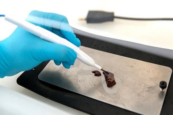 Chẩn đoán ung thư dễ dàng hơn với thiết bị iKnife