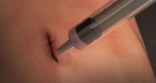 Tương lai sẽ có keo chữa lành vết thương trong 60 giây