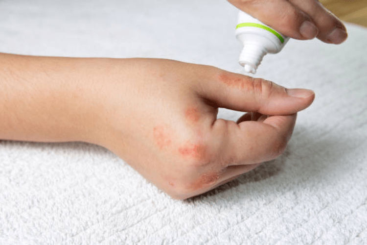 TP.HCM: Mỗi ngày có đến 100 người bị kiến ba khoang tấn công phải nhập viện