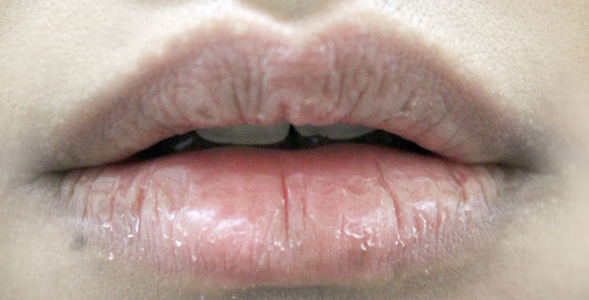 Giúp đôi môi không còn khô nứt