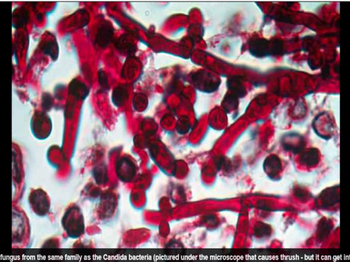 Siêu nấm nhiễm bệnh do dùng chung nhiệt kế