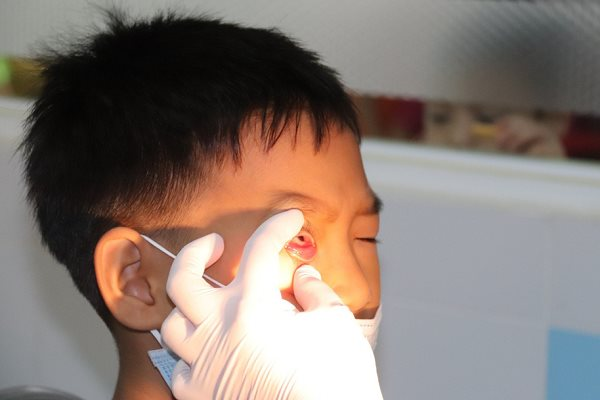 Nguyên nhân nào gây bùng phát bệnh đau mắt đỏ tại TP.HCM?