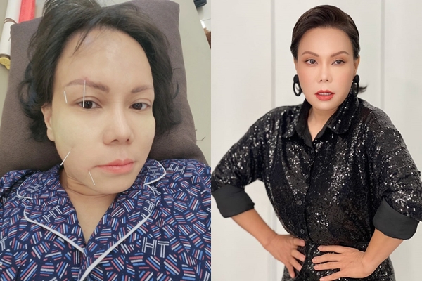 Tình trạng sức khỏe của Việt Hương sau sự cố bị méo mặt 
