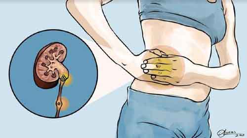 6 biểu hiện báo hiệu bạn bị bệnh sỏi thận