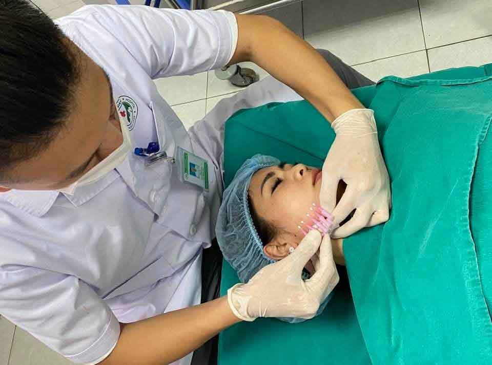 Căng chỉ collagen liệu có thực sự an toàn?