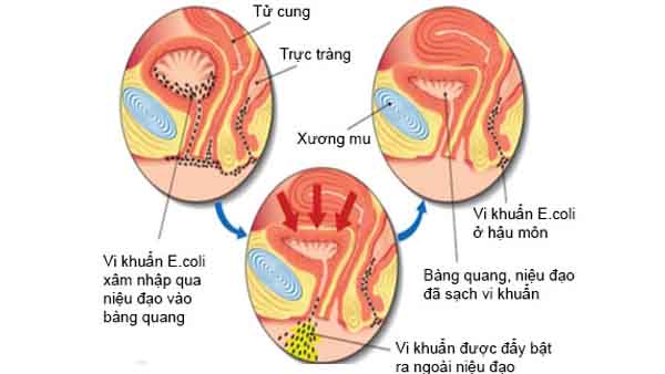 Nhiễm khuẩn Ecoli – bệnh thường gặp không nên chủ quan