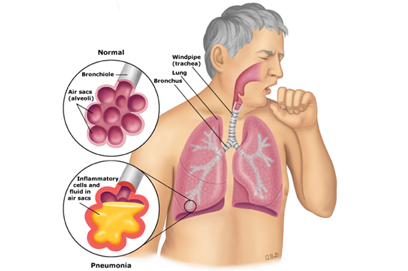Bệnh viêm phổi – Bạn cần lưu ý những gì?