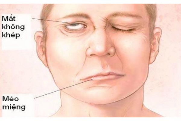 Méo miệng, lệch mặt vì rét đậm