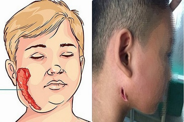 Những biểu hiện thường gặp của chứng bệnh Whitmore